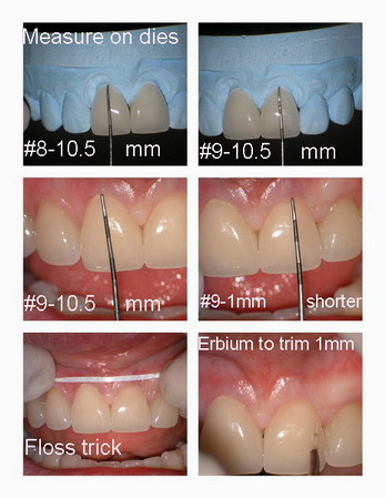 Insertion of veneers pg 3_resize_resize.jpg